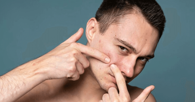Does Creatine Cause Pimples? Myth vs. Reality