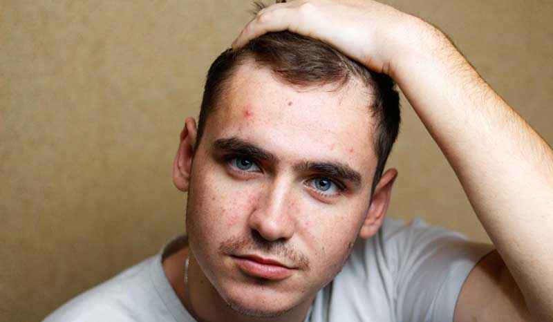 Does Creatine Cause Acne? Science Explains