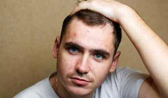 Does Creatine Cause Acne? Science Explains