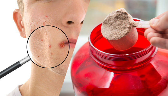 Does Whey Protein Cause Acne?
